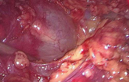 肾囊肿手术视频,专业视频带你直观了解